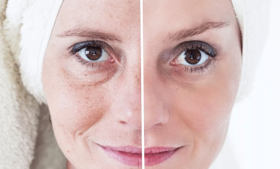 lasersko pomlajevanje obraza